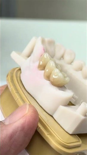 4 unit bridge from two teeth