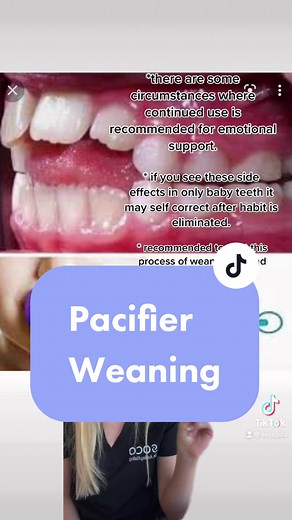 Weaning Tips for Baby Pacifiers: Expert Advice from Pediatric Dentist