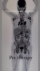 Pre and post therapy PET MIP IMAGES | Nuclear Medicine imaging and Theranostics