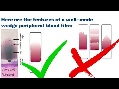 Mastering Blood Film Preparation and Examination