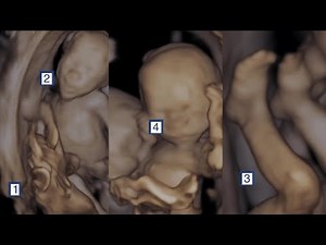 Identical quadruplets born at Banner Health, beating 1-in-40-million odds