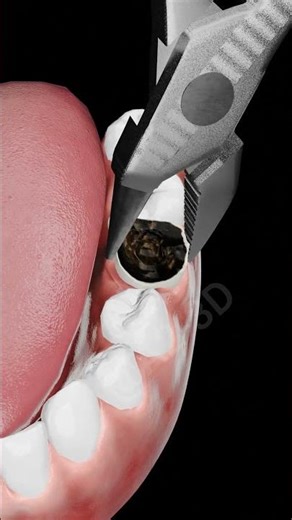 Tooth Extraction 3D Animation