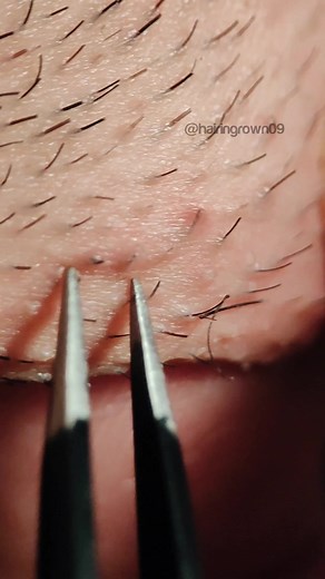 #extraction #ingrownhair #waxingvideos #ingrownhairpull #tweezers #foryou