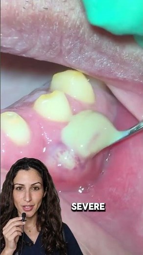 Never Pop a Gum Abscess at Home!