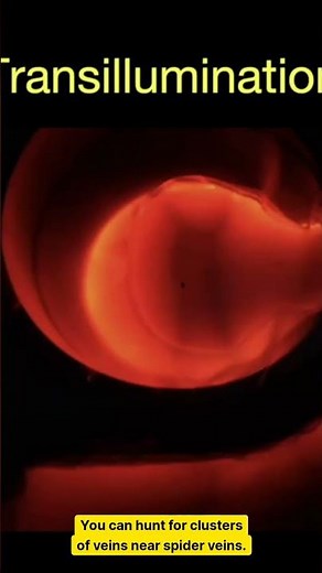 What Causes Spider Veins! 🕷️ Advanced Sclerotherapy Techniques: Guide for Doctors and Nurses