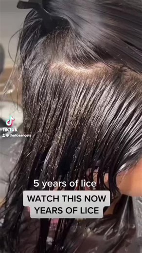 ⚠️⚠️5 Years of head lice & our treatment worked in 50 minutes⚠️⚠️ #Fyp #Fy #Foryou #Foryoupage #Lice #Lasvegas #Vegas #Backtoschool #momsoftiktok #dadsoftiktok #Hair #Bugs #Organic