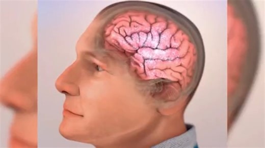 Understanding New Treatment Options for Alzheimer’s Disease