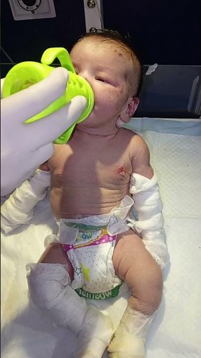 Staphylococcal Scalded Skin Syndrome (SSSS) recovery