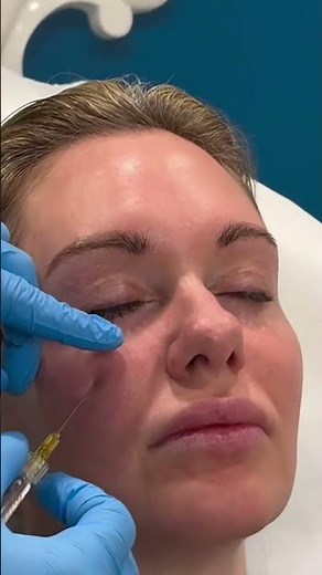 Tear Trough Filler with Dr. Dahabra | Under Eye Filler Technique Explained Step by Step #shorts