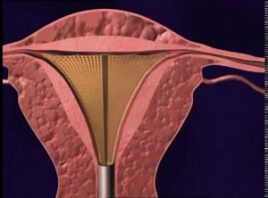 NovaSure Endometrial Ablation is a one-time, 5-minute procedure that gently removes the endometrium, or the lining of the uterus (the part that causes the bleeding), with a quick delivery of radio frequency energy. 95% of patients were satisfied with the results 97% said they would recommend NovaSure® to a friend
