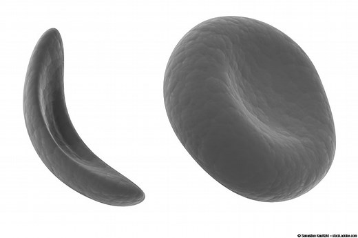 10 Things You Should Know About Sickle Cell Disease