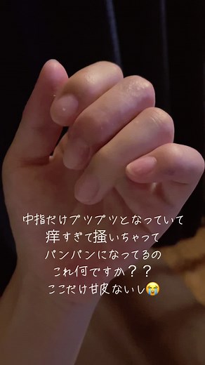 手の乾燥と湿疹の悩み対策