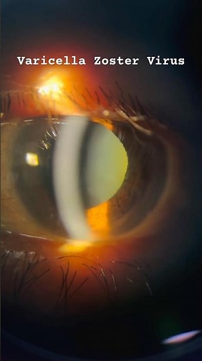 😳 “This Virus Can Attack Your Eye! | Shingles in the Eye Explained 👁”