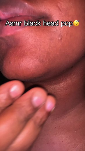 ASMR Black Head pop #asmr #blackhead #pimple #asmrsounds #viral