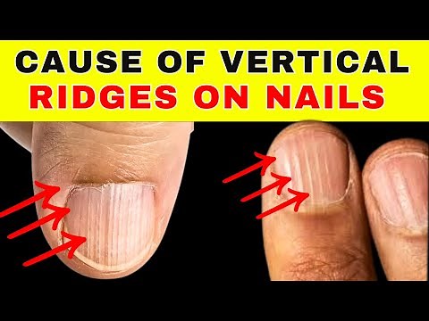 Do You Have Vertical Nail Ridges? Here’s What They Mean!