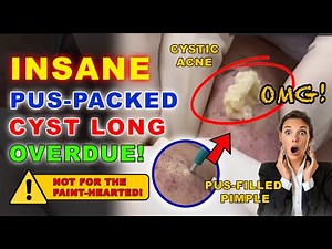 Accidentally stumbled upon a cyst-popping video — what happened next left everyone speechless!