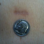 Microdiscectomy and Microdecompression NYC