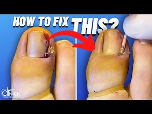 How to permanently remove an INGROWN TOENAIL! 😱| Dr. Nick Campitelli
