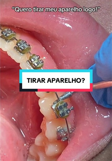 Como evoluir no tratamento do aparelho ortodontico