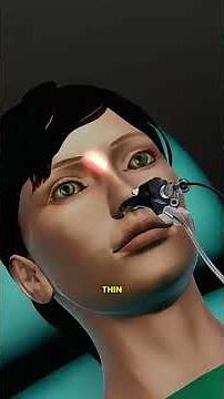 Medical Animation 🇱🇷 Understanding Balloon Sinuplasty for Chronic Sinusitis