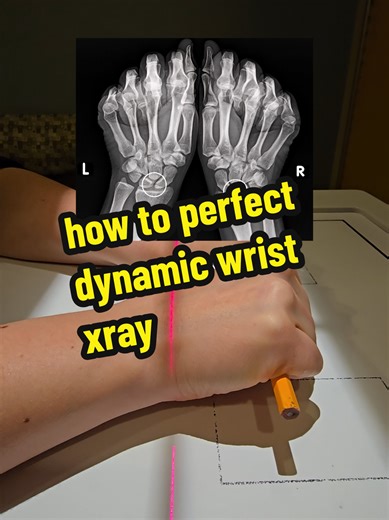 You can do the exam without the pencil but it definitely helps keep the wrists more uniform in this dynamic wrist demonstration. The scapholunate joint can appear normal on a regular wrist xray and hide its injury. So a view under normal stress can be helpful to get another look. . An ortho radiology tech gets to learn all sorts of unique things. #radtechlife #xraytech #radiologytech #xraystudent #creatorsearchinsights