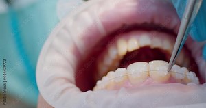 Close-up an open mouth with optragate and ceramic braces on the teeth and orthodontist is using dental forceps to putting white ligature ties on braces. The patient is having orthodontic treatment.