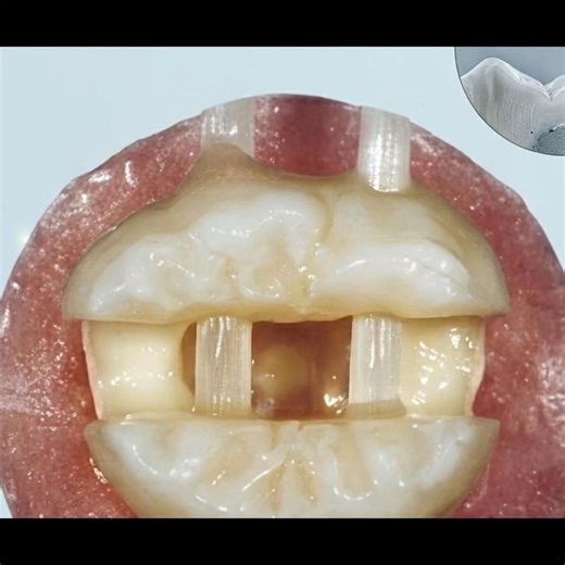 Biomecánica estomatológica: apoyos, vigas y tensores. #estomatología #dental #odontologia #diente