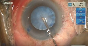Phacoemulsification in Intumescent Cataract - Eyetube