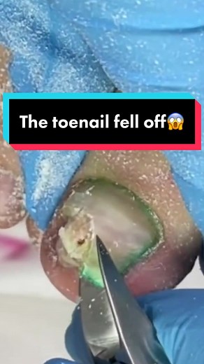 The toenail fell off from trauma and onycholysis🤕😱 #nail #nails #manicure #pedicure #feet #foot #injury #ingrown #ingrowntoenail #ingrowntoenailremoval
