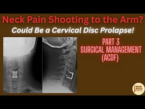 ACDF Surgery Explained| Anterior Cervical Discectomy & Fusion| Neck Disc Prolapse Surgical Treatment