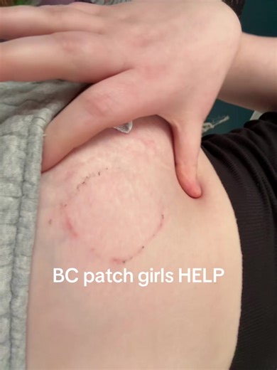 anyone else have this problem with the xulane patch? i used to be able to put them on my thighs with no problem but then it started causing those red areas #fypシ #birthcontrol #birthcontrolpatch #girlies #girls