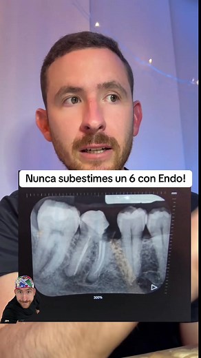 Extracciones dentales complejas: Un caso desafiante