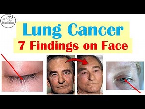 7 Findings on the Face That Can Reveal Lung Cancer Early