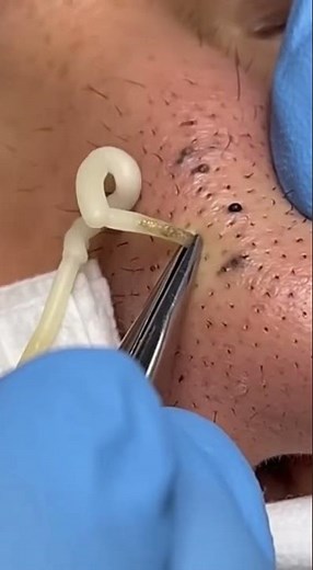 The Blackhead That NEVER Ends! | Long Filament Extraction on the Nose