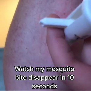 Bug Bite Thing on Instagram: "Bug Bite Thing uses suction—no chemicals, JUST suction—to remove the saliva/venom left under the skin from bug bites and stings.🦟🐝 When you remove the irritant the body stops reacting! www.bugbitething.com 👶 Kid-Friendly 🚫 Chemical-Free ♻️ Reusable 💵 100% Money Back Guarantee"
