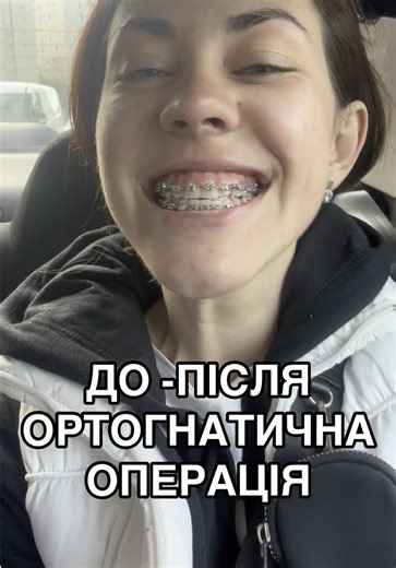 Ортогнатична операція: До і після
