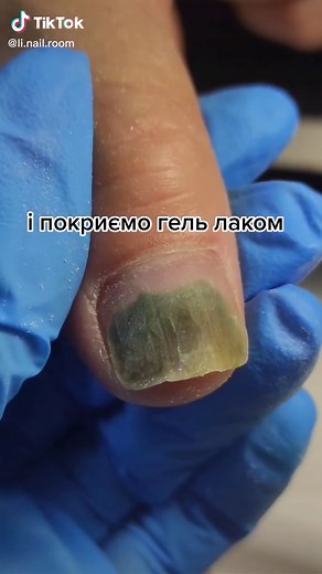 Understanding Nail Discoloration and Health Issues