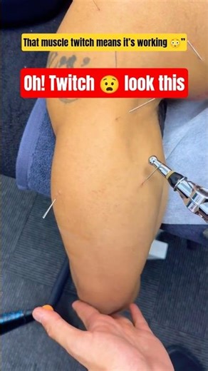 Shoulder Dry Needling (Anterior Deltoid) | Trigger Point Release (Watch the Twitch 😳)