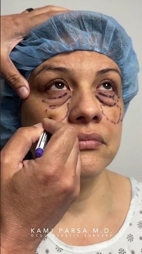 Incredible Eye Bag Removal Transformation | 1 Month After Trifecta Lift | Dr. Kami Parsa