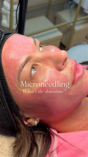 Downtime Guide to Microneedling ✨ ⏱️ 홄홢홢홚홙홞홖황홚홡홮 혼홛황홚홧 (0–24 홝홤홪홧홨)...