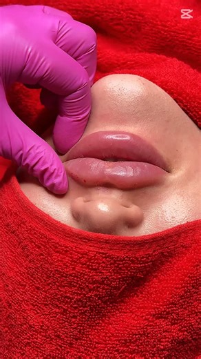 NAMUNA QOBILOVA | KOSMETOLOG TASHKENT👩🏻‍🔬 on Instagram: "Lips 👄 #lips #kosmetologi"