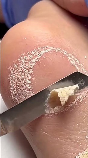 Deep Foot Texture Renewal | Heel Scraping