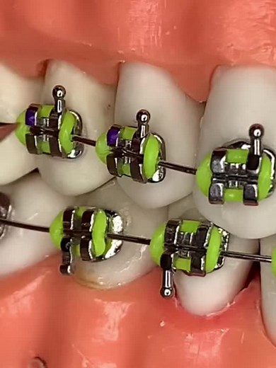 Dental Braces Application Process: Step-by-Step Guide