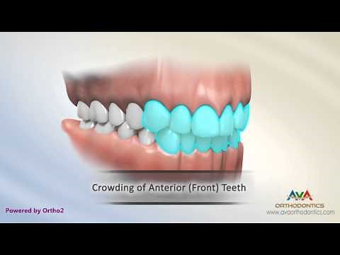Malocclusion - Class I