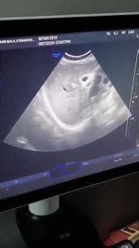 Multiple Hepatic hydatid cyst.