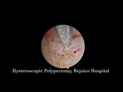 Hysteroscopic Polypectomy