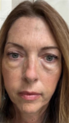 Jennifer Leigh Vaughan on Instagram: "Merrry Christmas to me!!! #55 #facelift #necklift #blepharoplasty #co2laser"