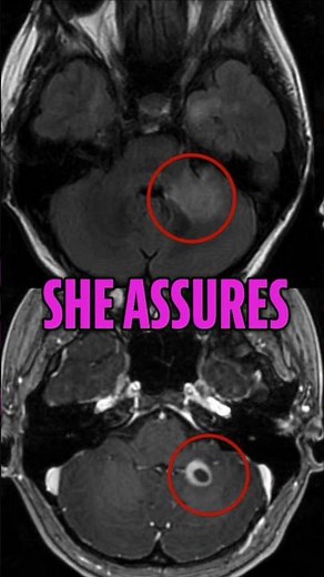 Exploring the Mystery of Brain Lesions 🧠🔍