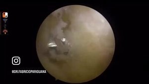 FHL arthroscopic transfer