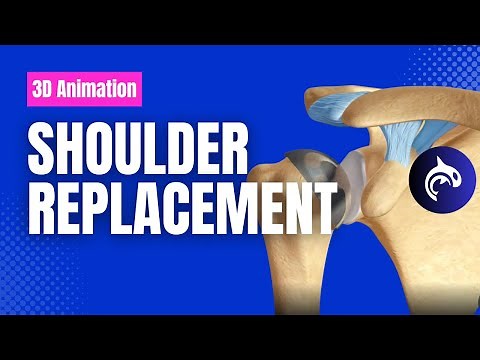 Shoulder Replacements: Total vs. Reverse vs. Partial